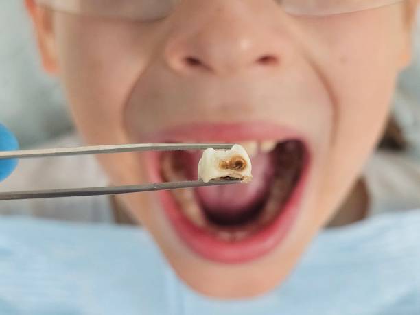 Best Emergency Wisdom Tooth Extraction in Lincroft, NJ